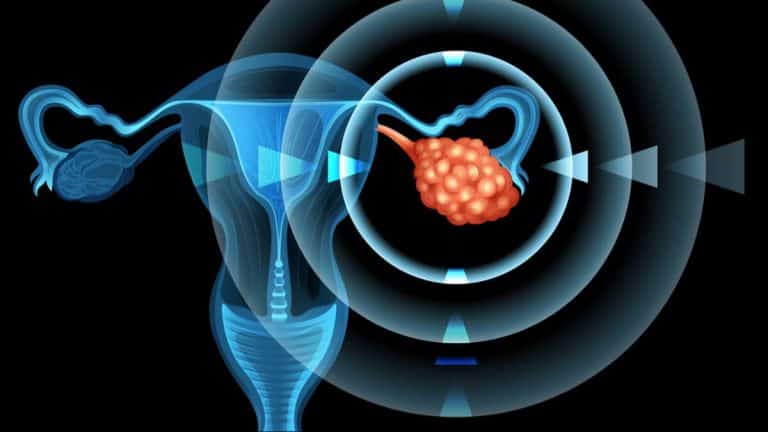 Riesgo de cáncer de ovarios: la conexión entre el consumo de grasas trans revelada en este blog