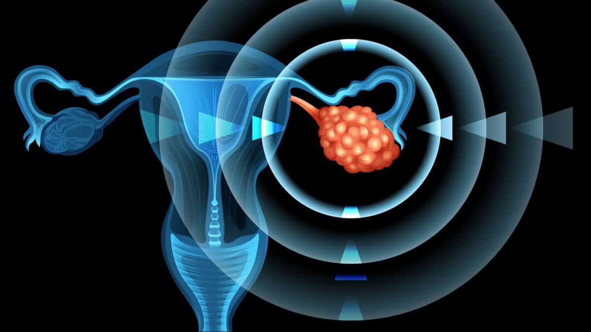 riesgo de cancer de ovarios la conexion entre el consumo de grasas trans revelada en este blog